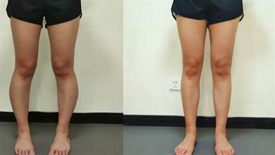 簡單5個動作，改善XO型腿、假胯寬，矯正腿型不是夢